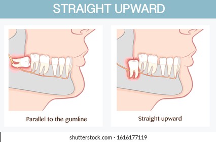 Impacted wisdom tooth  vector illustratin