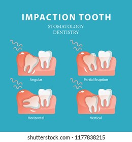 Impaction tooth. Dentistry stomatology vector