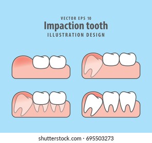 Impaction tooth illustration vector on blue background. Dental concept.