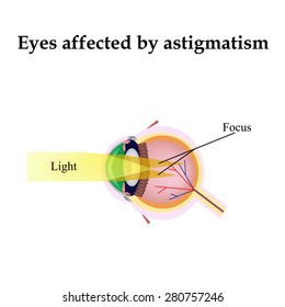 Impaired vision with astigmatism. As astigmatism affect vision.