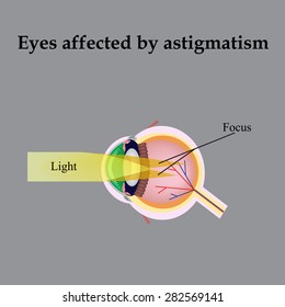 Impaired vision with astigmatism. As astigmatism affect vision.