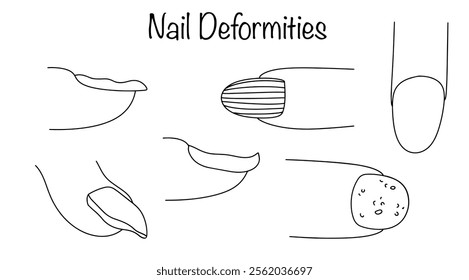 Impairment in the smoothness and shape of nails, caused by external or internal reasons. Hand-drawn main types of nail plate deformation. Simple black and white illustration.