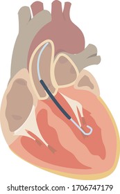 Impella Support In Heart Failure