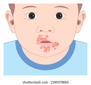 Impetigo Oral Poison Ivy Sepsis Bacterial Children Dermatitis Disease Warts HPV Virus Blister Face Acne Itchy Skin Soreness Reddish Cancer Ulcer Mouth Viral Cold Zoster Lip Rash Nose Baby Infant