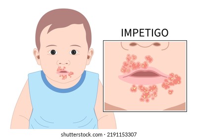 Impetigo Oral Poison Ivy Sepsis Bacterial Children Dermatitis Disease Warts HPV Virus Blister Face Acne Itchy Skin Soreness Reddish Cancer Ulcer Mouth Viral Cold Zoster Lip Rash Nose Baby Infant