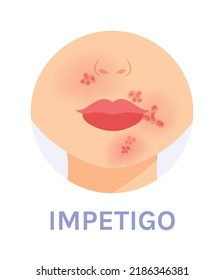 Impetigo. Skin Infection. Red Spots near the Mouth and Nose. Part of a Woman Face. Female Lips Nose and Neck. Color Cartoon style. White background. Vector image for Medical and Dermatology Design. 