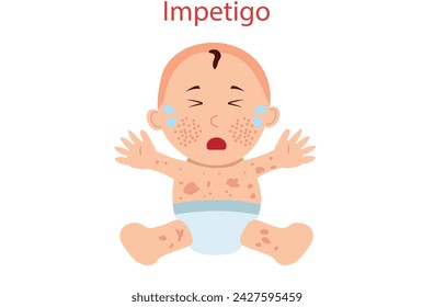 impetigo,impetigo oral poison ivy sepsis bacterial children dermatitis disease warts HPV virus blister face acne Itchy skin soreness reddish cancer ulcer mouth viral cold zoster lip rash nose baby