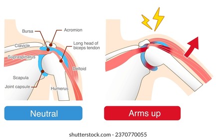 Impingement Syndrome. Causes and Mechanisms of Pain When Raising the Arm