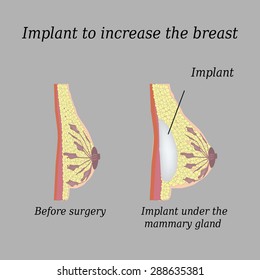 The implant in the breast on a gray background. Mammary gland.
