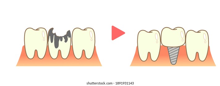 Implant Caries and Progression and Treatment: Dental Illustration