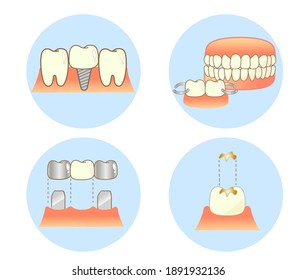 Implant Caries and Progression and Treatment: Dental Illustration