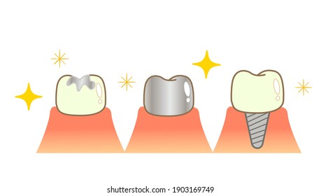 Implant Caries and Progression and Treatment: Dental Illustration