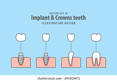 Implant & Crowns teeth illustration vector on blue background. Dental concept.