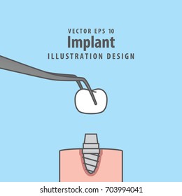 Implant illustration vector on blue background. Dental concept.