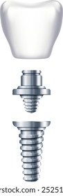 Implant parts illustration. Dental prosthesis. Orthodontic scheme