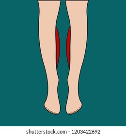 Implant in shins, lipofilling of lower legs before and after. Vector illustration