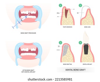 Antes y después de la comparación del implante dental la anatomía odontológica