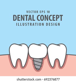 Implant tooth between real teeth illustration vector on blue background. Dental concept.