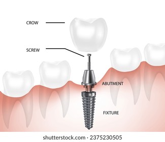 implant, tooth, dental, vector, denture, component, prosthetics, molar, jaw, dentist, medical, icon, health, fixation, treatment, root, clinic, dentistry, human, decorative, surgical, stomatology, ena