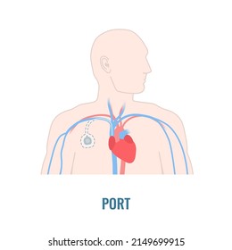 Implantable Venous Access Port. Under The Skin Central Line Access Device For Chemotherapy Infusion, Medication Administration And Blood Drawing. Medical Vector Illustration.