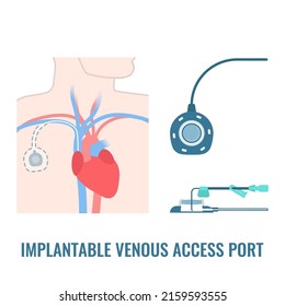 Implantable Venous Access Port. Under The Skin Central Line Access Device For Chemotherapy Infusion, Medication Administration And Blood Drawing. Medical Vector Illustration.