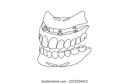 Implantation of a denture on the upper jaw. Prosthetics of the upper dentition. Three-quarter jaw rotation. One line drawing for different uses. Vector illustration.