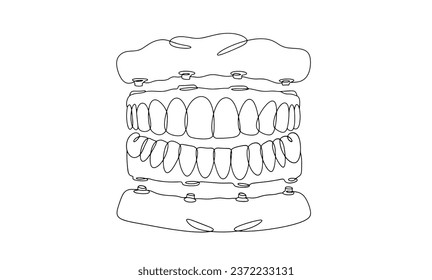 Implantation of dentures on the upper and lower jaw. Complete dental restoration. One line drawing for different uses. Vector illustration.