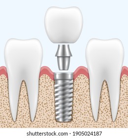 Implantation of human tooth process in realistic style. Stomatological restoration, rehabilitation on implant. Dental crown procedure. Prosthodontic treatment. Vector medical illustration.