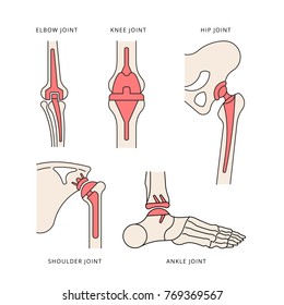 implantation joint skeleton