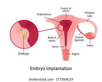 implantation. stage of pregnancy when embryo adheres to the wall of the uterus. Embryo close up. Parts of uterus are marked with lines. Vector medical illustration.