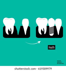 Implantation of the tooth. Dental prosthesis icon. Stomatology