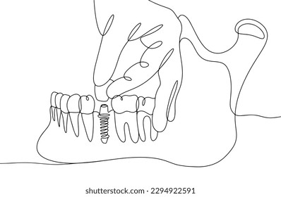 Implantación de un diente en la mandíbula inferior de una persona. El trabajo de un técnico dental. Día Europeo de Técnicos Dentales. Un dibujo de línea para diferentes usos. Ilustración vectorial.