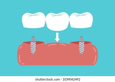 implants in gums supported dental bridge