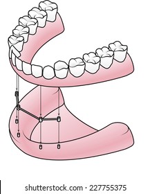 Implant-secured removable denture: A removable full denture attaching to a bar retainer that is in turn attached to four implant posts.