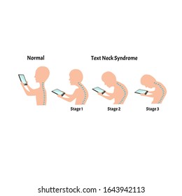 Improper posture symptoms. Stage Text Neck Syndrome. Spinal curvature, kyphosis, lordosis, scoliosis, arthrosis. Improper posture and stoop. Infographics. Vector illustration on isolated background.