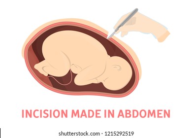 Incision making stage of birth via cesarean section. Fetus movement during the c-section. Biology and gynecology. Isolated vector illustration