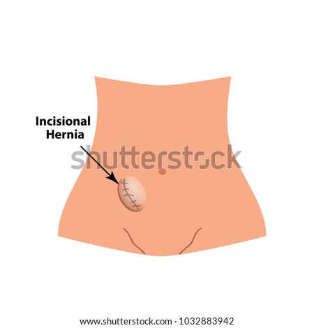incisional hernia. intestinal hernia. Infographics. Vector illustration on isolated background.