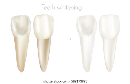 Incisors before and after teeth whitening. Made with gradient mesh. Vector illustration.