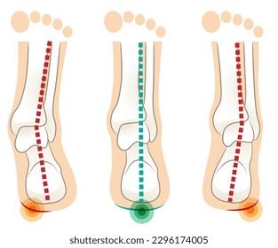 Inclination of calcaneus and heel of right foot seen from behind