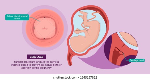 Incompetent Cervix Cervical Insufficiency Weak Tissue Stock Vector ...