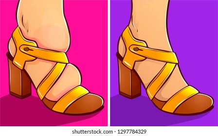 Inconvenient Shoes, Swelling Of The Feet. Before, After. Vector Illustration.