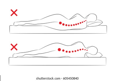 The incorrect spine alignment when sleeping by on the side sleeping position.
