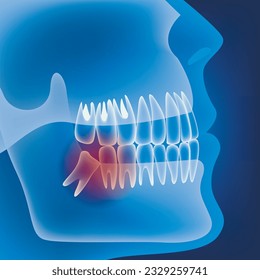 Incorrect wisdom tooth growth. Light profile. Medical poster. Verctor illustration