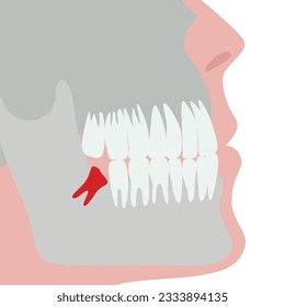 Incorrectly growing wisdom tooth. Medical diagram for backgrounds or advertising. Vector illustration