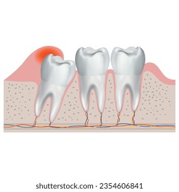 Incorrectly growing wisdom tooth. Realistic medical illustration, poster, infographic. Vector illustration