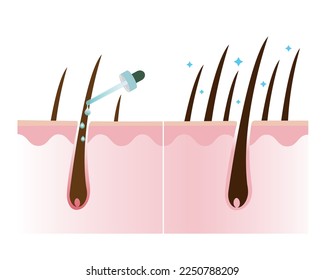 Increase hair density treatment with scalp layer vector isolated on white background. Treat loss, thin hair and fall and make thicker. Hair care concept illustration. 