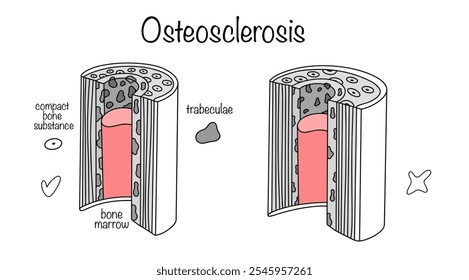 Erhöhte Knochendichte, manifestiert als Verdickung von Knochentrabekulen und kompakter Knochensubstanz. Gesunde Knochen und mit Osteosklesor gezogen. Vektorgrafik für den Einsatz im medizinischen Bereich.