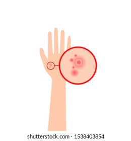 increased scheme eczema on human hand. representation patient’s arm with an allergic reaction like an dermatitis. image of skin disease and rash symptoms. simple flat vector for medical sites, apps