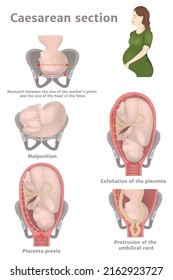 Indications for caesarean section. Exfoliation of the placenta, incorrect position of the fetus, protrusion of the umbilical cord. Pregnant woman. Medical poster. Vector illustration