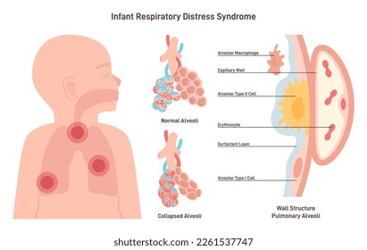 Infant respiratory distress syndrome. Congenital pathology of baby's lungs are not fully developed. Breathing difficulties, colllapsed alveolus. Flat vector illustration